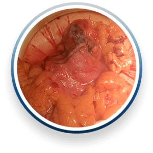 partial-colectomy